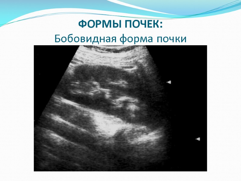 ФОРМЫ ПОЧЕК: Бобовидная форма почки